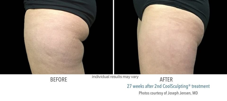 Before and after CoolSculpting treatment on the upper legs.