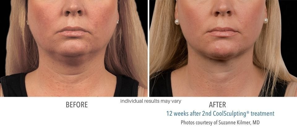 Before and after CoolSculpting treatment on the chin area.