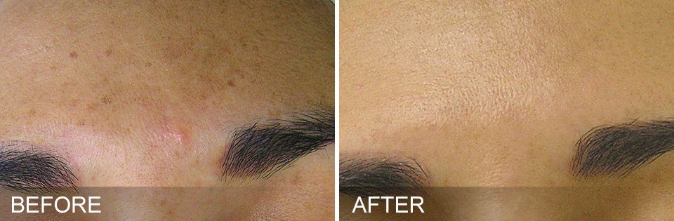 before and after Brown Spots