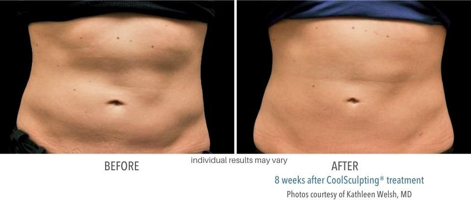 Before and after CoolSculpting treatment on the abdomen.