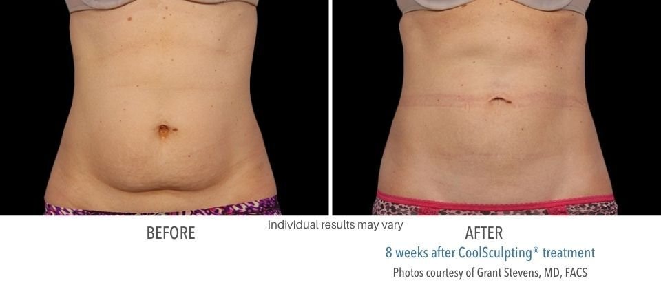 Before and after CoolSculpting treatment on the stomach.