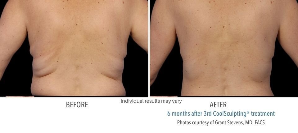 Before and after CoolSculpting treatment on the back.