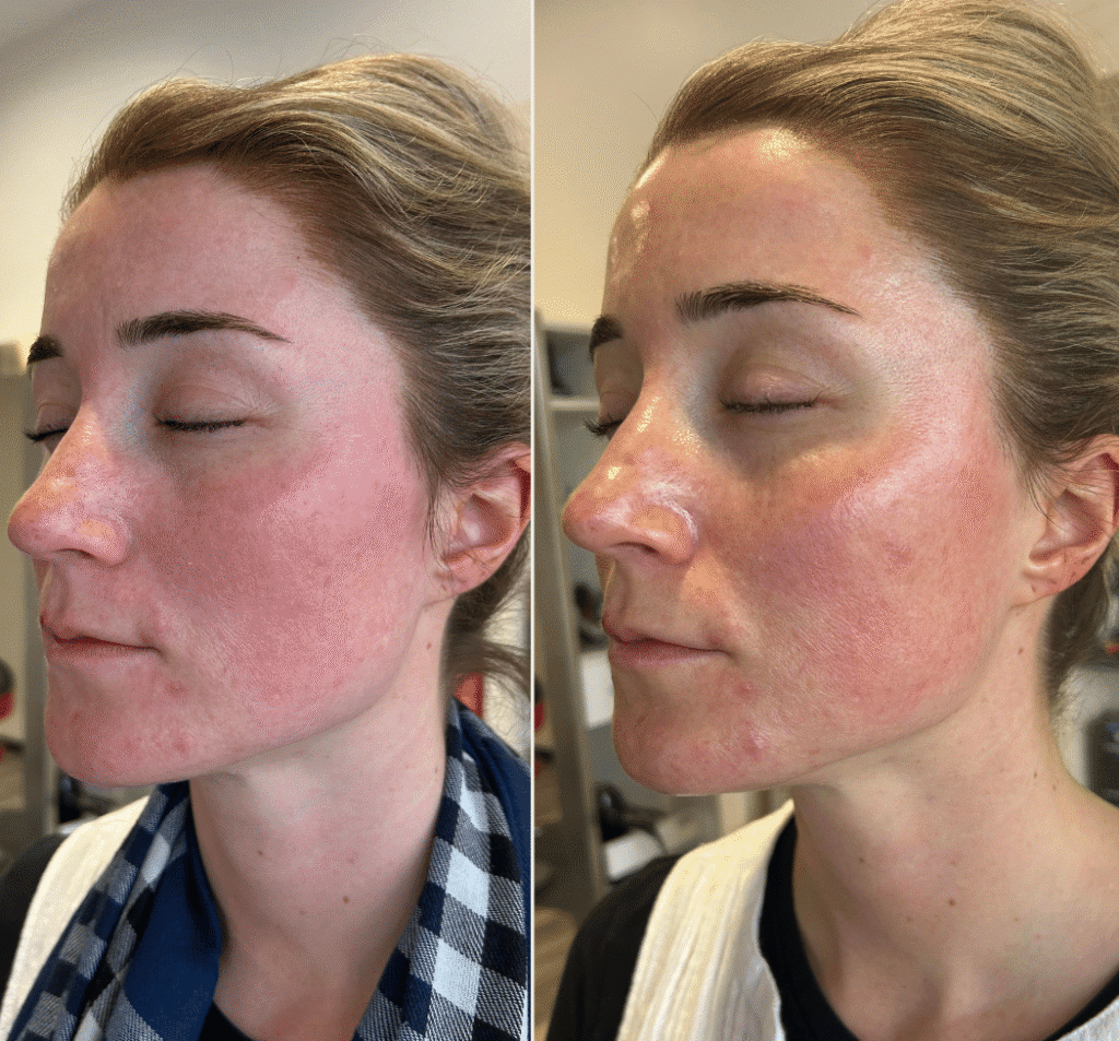 A before-and-after comparison showing improved skin texture and reduced redness after a hydrafacial treatment, demonstrating the effective skincare results achieved at Spitale Laser Spa Salon.