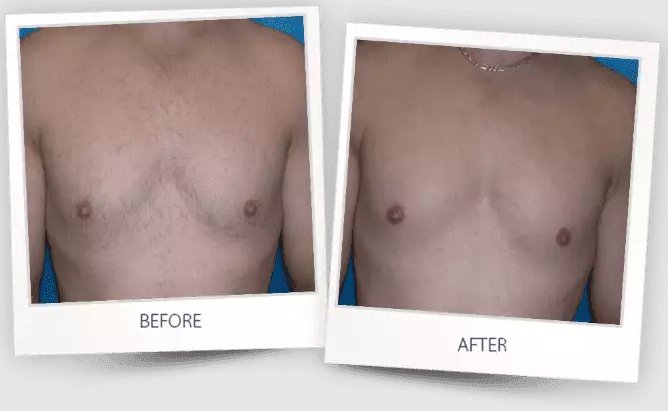 Before and after of a chest.