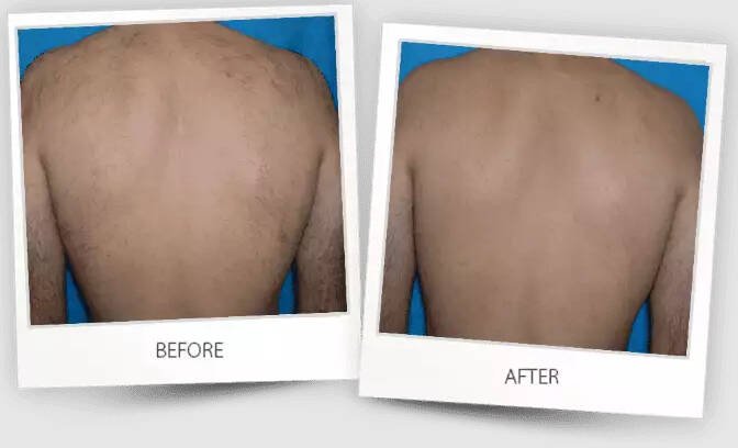 Before and after of a back.