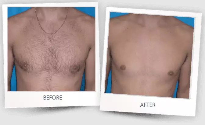 Before and after of a chest.